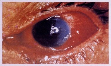 A complication of temazepam injection.